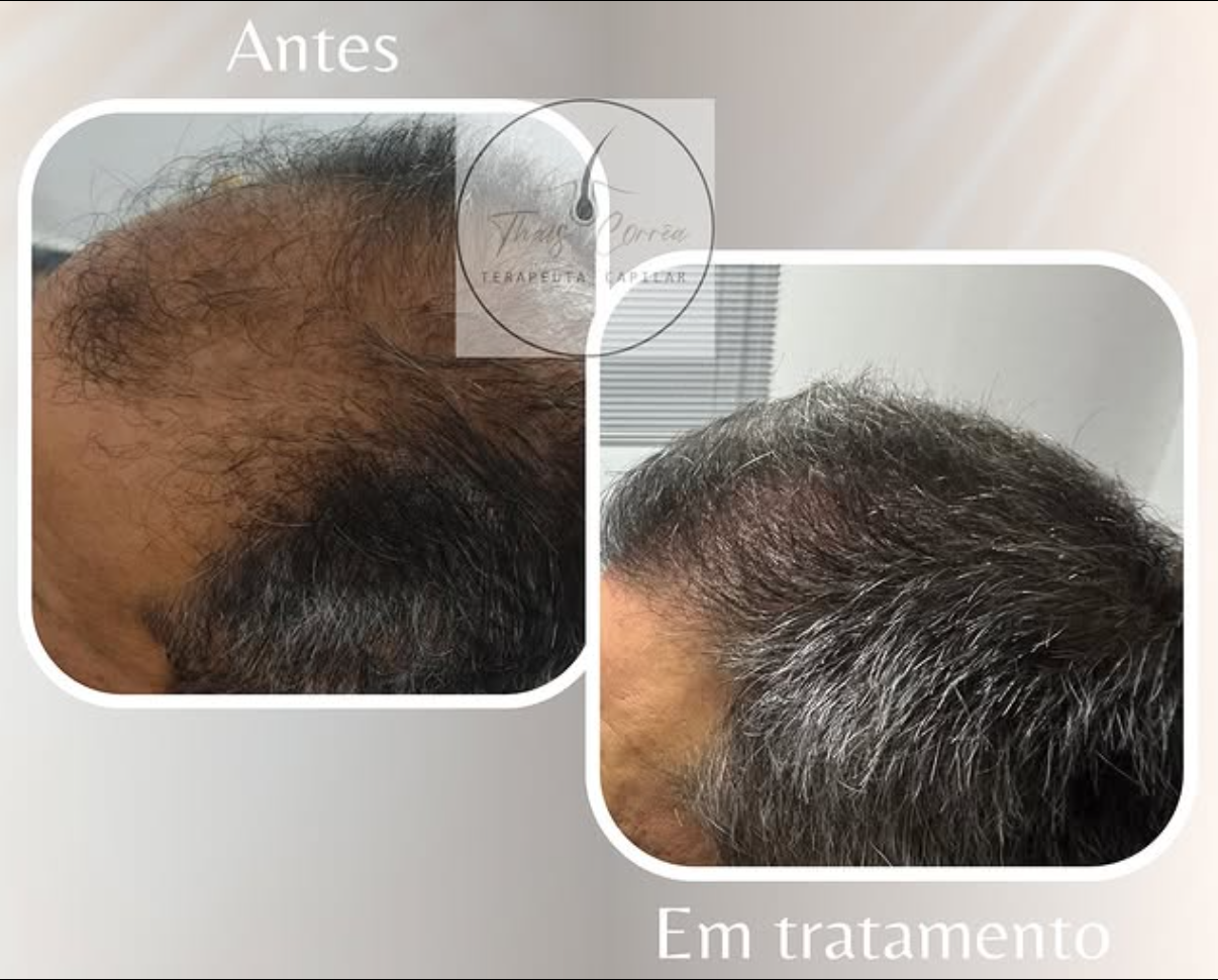 Antes e durante tratamento capilar Correttha