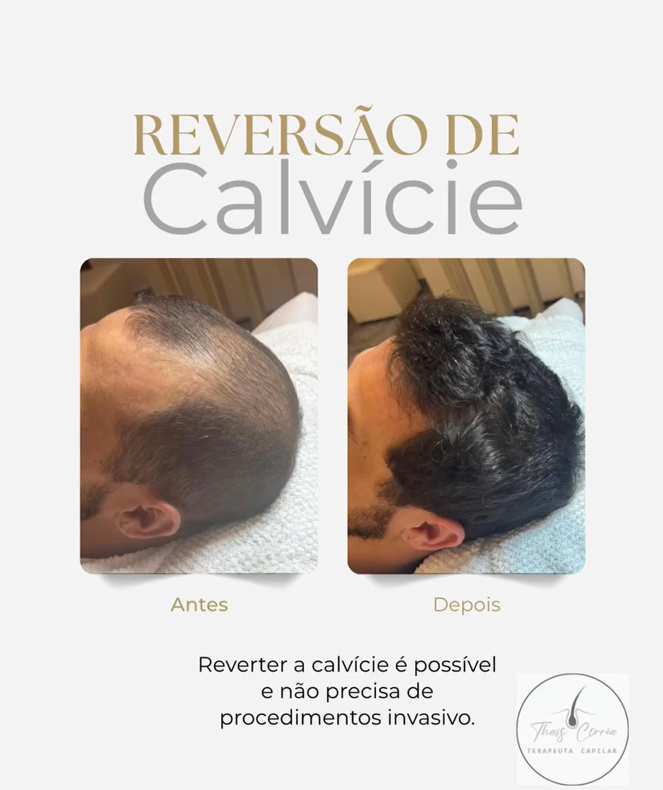 Reversão de calvície — antes e depois Correttha